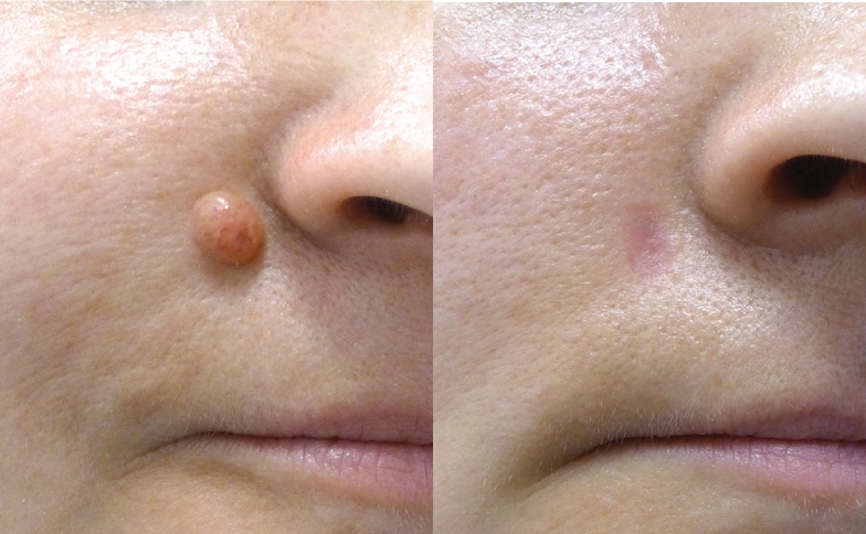 What You Should Do To Find Out About Mole Removal Before You're Left Behind