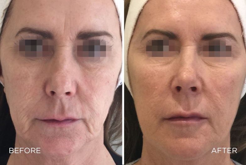 Profhilo Skin Boosting Injections - Good Skin Days Leeds