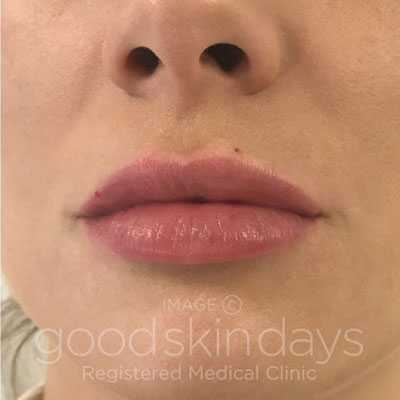 Lip Fillers in Leeds - After