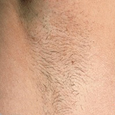 Laser hair removal in Leeds - Before